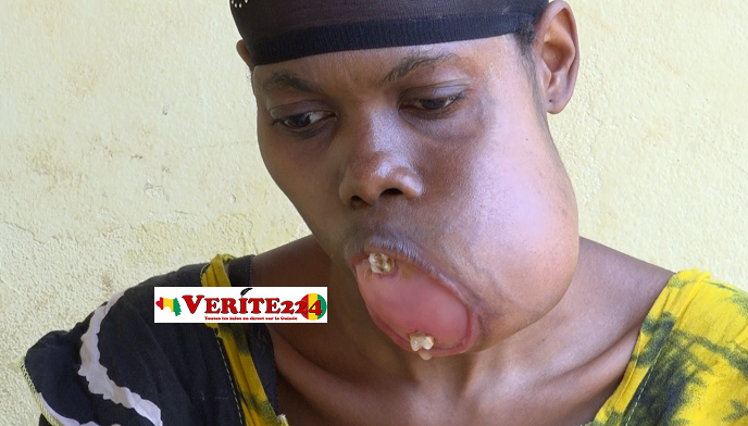 Fatoumata Sylla souffre d'une tumeur à la bouche