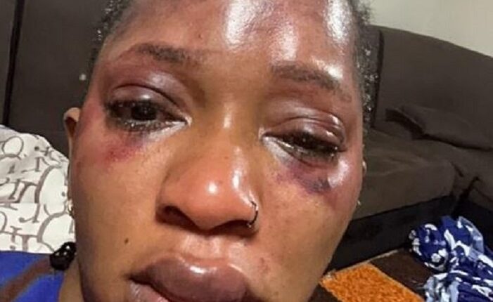 La chanteuse Djelykaba Bintou publie des photos pour témoigner les violences conjugales dont elle a fait l'objet